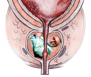 Per la serie "Orribili patologie viscerine": il vero problema della prostata del Dell'Utri? Una "vittoriomanganite" acuta. Curabile? S, certo, ma le cure costano milioni di euro. Meno male che il Dell'Utri ha amici ricchi sfondati, se no sfondata (ma non ricca) ci finirebbe la sua prostata.